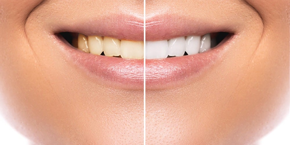 teeth care wantirna dentist tooth restoration